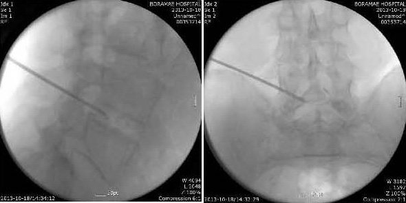 Yes Disc YES DISC – HiTECH Medic